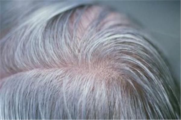 التوتر والوراثة سبب ظهور الشعر الأبيض