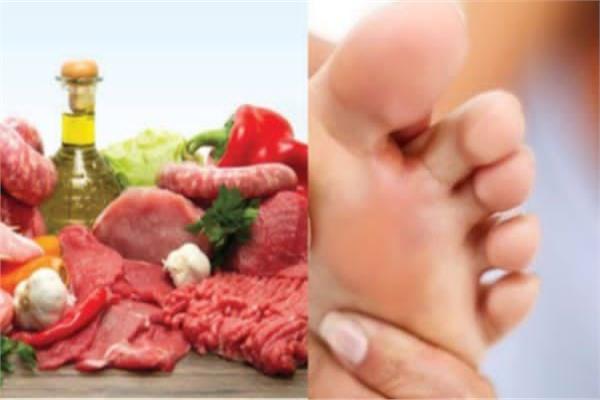 مرضى النقرس