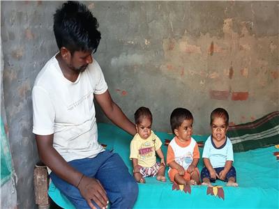 طولهم 50 سم.. مرض غامض يصيب ثلاثة أشقاء في الهند