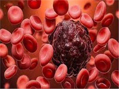 أطباء بريطانيون يستحدمون الهندسة الوراثية في علاج سرطان الدم