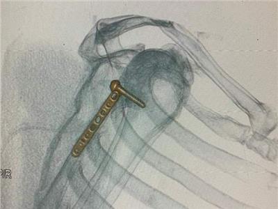 جراحة نادرة في مستشفى الأزهر بدمياط الجديدة 