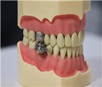 "قفل الأسنان".. أغرب جهاز في العالم لإنقاص الوزن