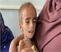 أطفال قندهار الأفغانية يموتون بسبب سوء التغذية