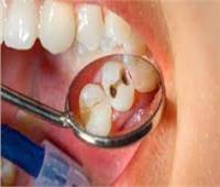 جهاز للكشف المبكر عن خطر تسوس الأسنان