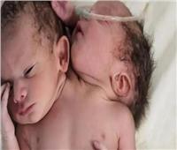 ولادة نادرة لطفل معجزة برأسين و3 أذرع في الهند