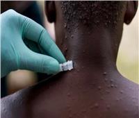 الصحة العالمية:لا دواء لجدرى القرود .. وتطعيم الجدرى ناجع معه بنسبه ٨٥%
