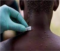منظمة الصحة العالمية : لاحاجة لحملات تطعيم جماعية ضد جدري القرود