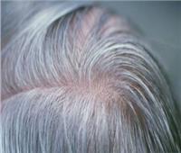 (واشتعل الرأس شيبا) .. العمر والتوتر والوراثة سبب ظهور الشعر الأبيض